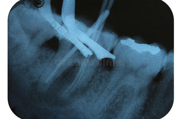 字母x-射线<strong>消极</strong>的牙牙髓病学的