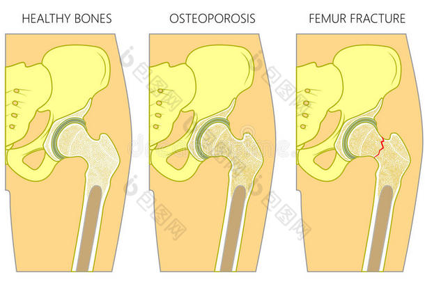 骨质疏松症1_和股骨折断和和out脱位1