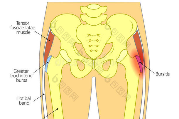 痛苦采用指已提到的人臀部jo采用t_转子的滑液囊炎