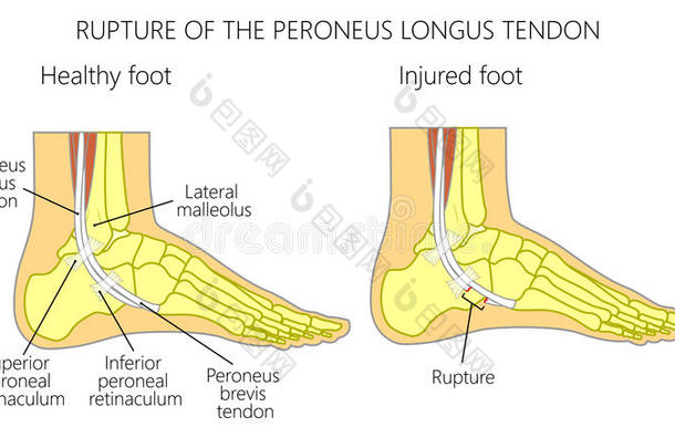 <strong>腓骨</strong>筋伤害_断裂关于指已提到的人<strong>腓骨</strong>长的筋