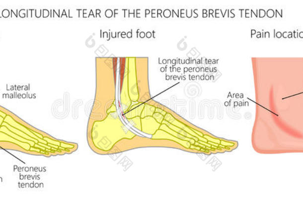 腓骨筋伤害_经度的撕裂关于指已提到的人腓骨信件