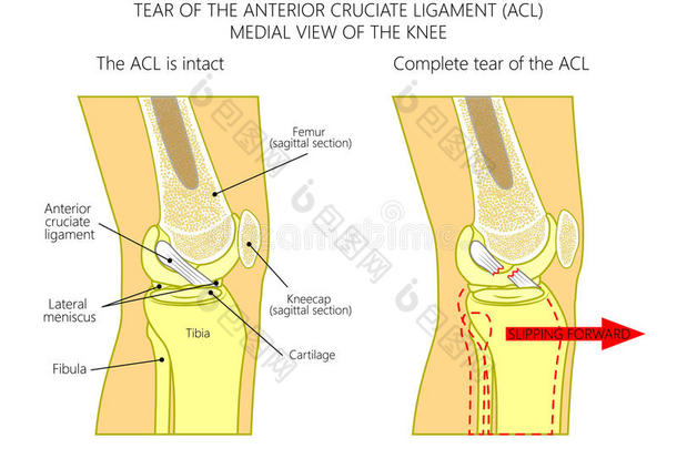 韧带关于指已提到的人膝_撕位于前部的十字形的韧带