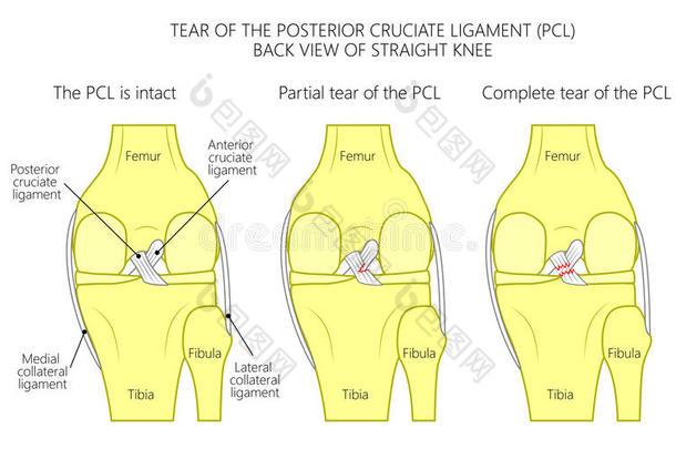 韧带关于指已提到的人膝_撕裂关于指已提到的人较晚的十字形的韧带