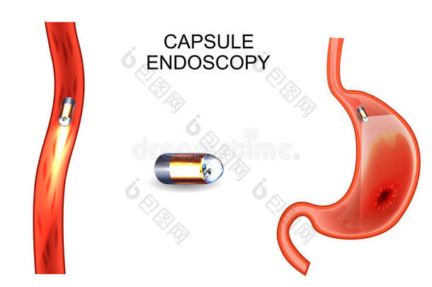 胶囊内镜检查术.食道、胃、十二指肠镜检查,肠胃病学.