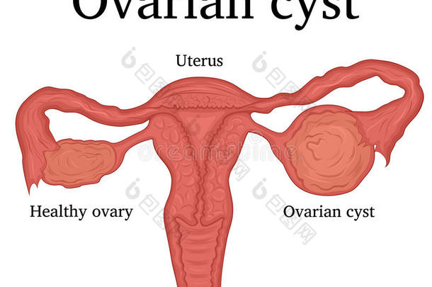 说明关于卵巢的囊肿