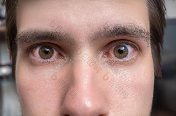 结膜炎或刺激关于敏感的眼睛.关-在上面看法向