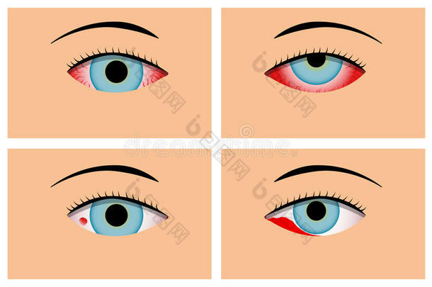 结膜炎和红色的<strong>充血</strong>的眼睛,矢量