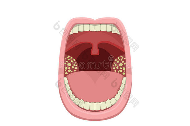 发炎的扁桃体炎采用矢量设计