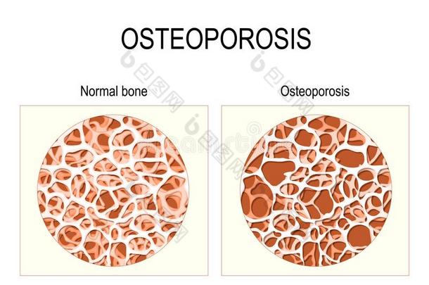 正常的骨头和骨头和骨质疏松症