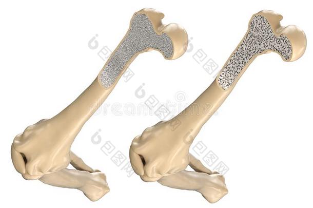 人<strong>股骨头</strong>-正常的和和骨质疏松症