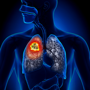 国际肺癌日